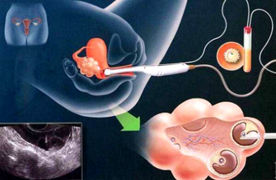 子宫内膜结核可以去格鲁吉亚做试管婴儿吗？
