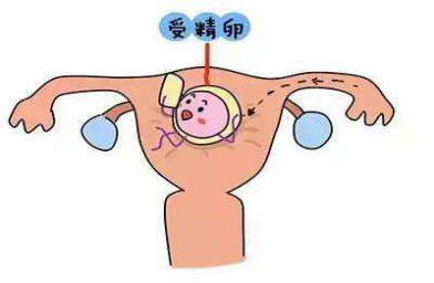 试管婴儿胚胎移植后腹部两侧疼是不是宫外孕？